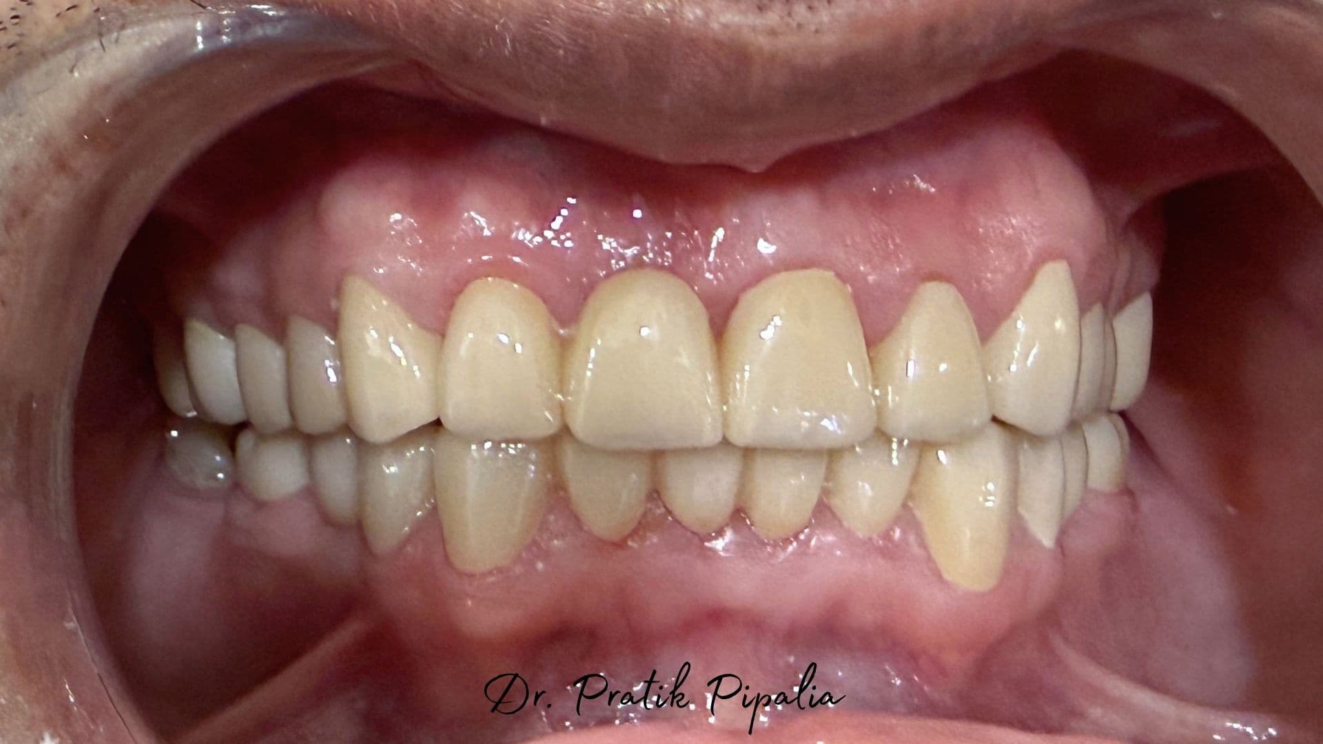 After treatment